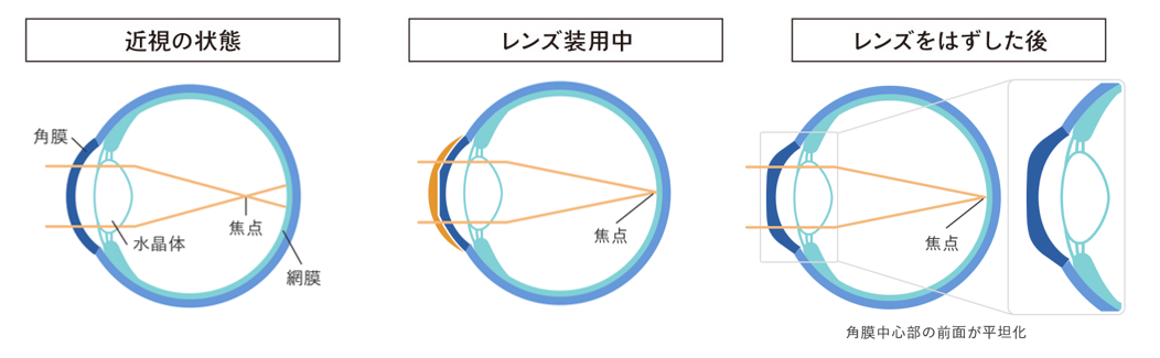 オルソケラトロジーの仕組み